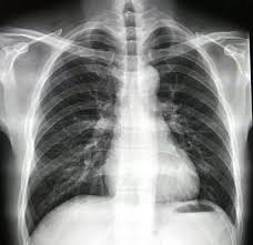 想看胸片曝光怎么办